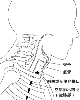 若聲帶下方的氣管被割斷，肺部吐出的空氣從傷口離開身體，通過聲帶的空氣就不足以造成震動及聲響。