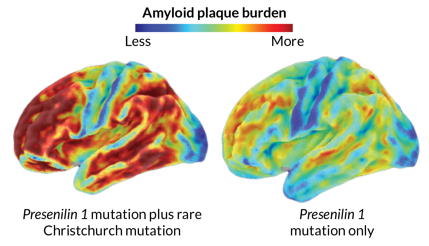 兩個與阿茲海默症有關的腦部掃描。左圖是哥倫比亞婦女，她有罕見的第二種突變，儘管她有很多類澱粉蛋白（紅色區域），該突變似乎能保護她直到70歲以後。右邊也是類澱粉蛋白沉積，其記憶問題從40歲左右就開始出現。